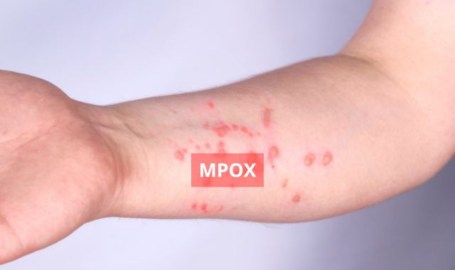 Mpox é confirmado em Porto Alegre