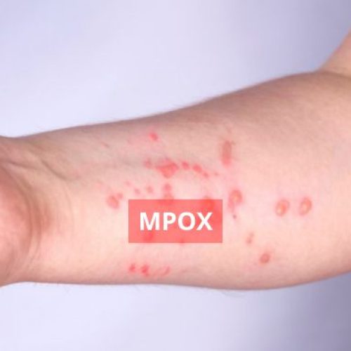 Mpox é confirmado em Porto Alegre