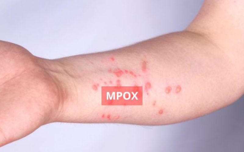 Mpox é confirmado em Porto Alegre